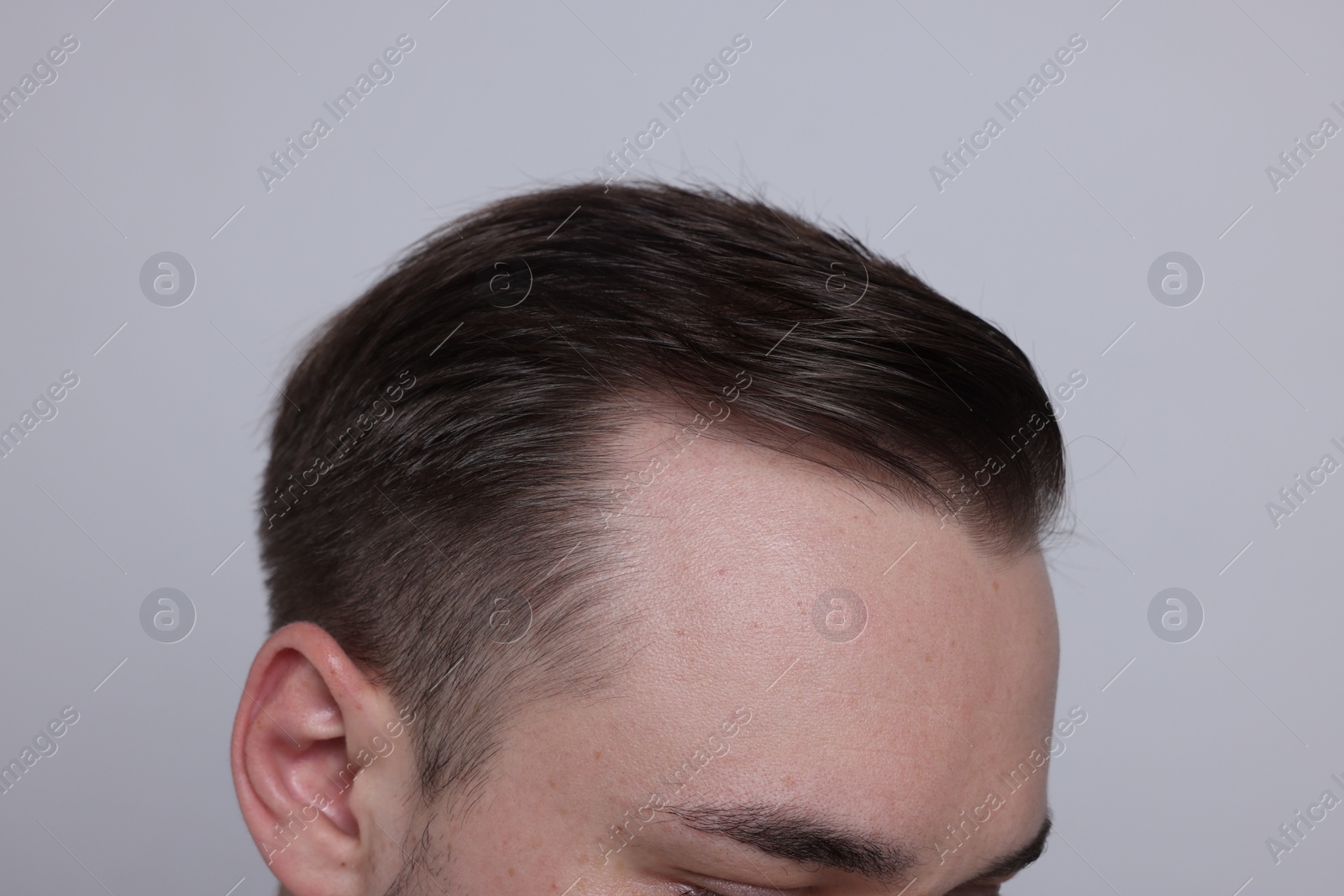 Photo of Baldness concept. Man with receding hairline on light grey background, closeup