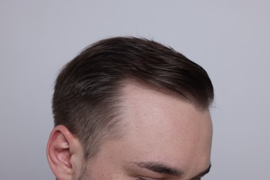 Baldness concept. Man with receding hairline on light grey background, closeup