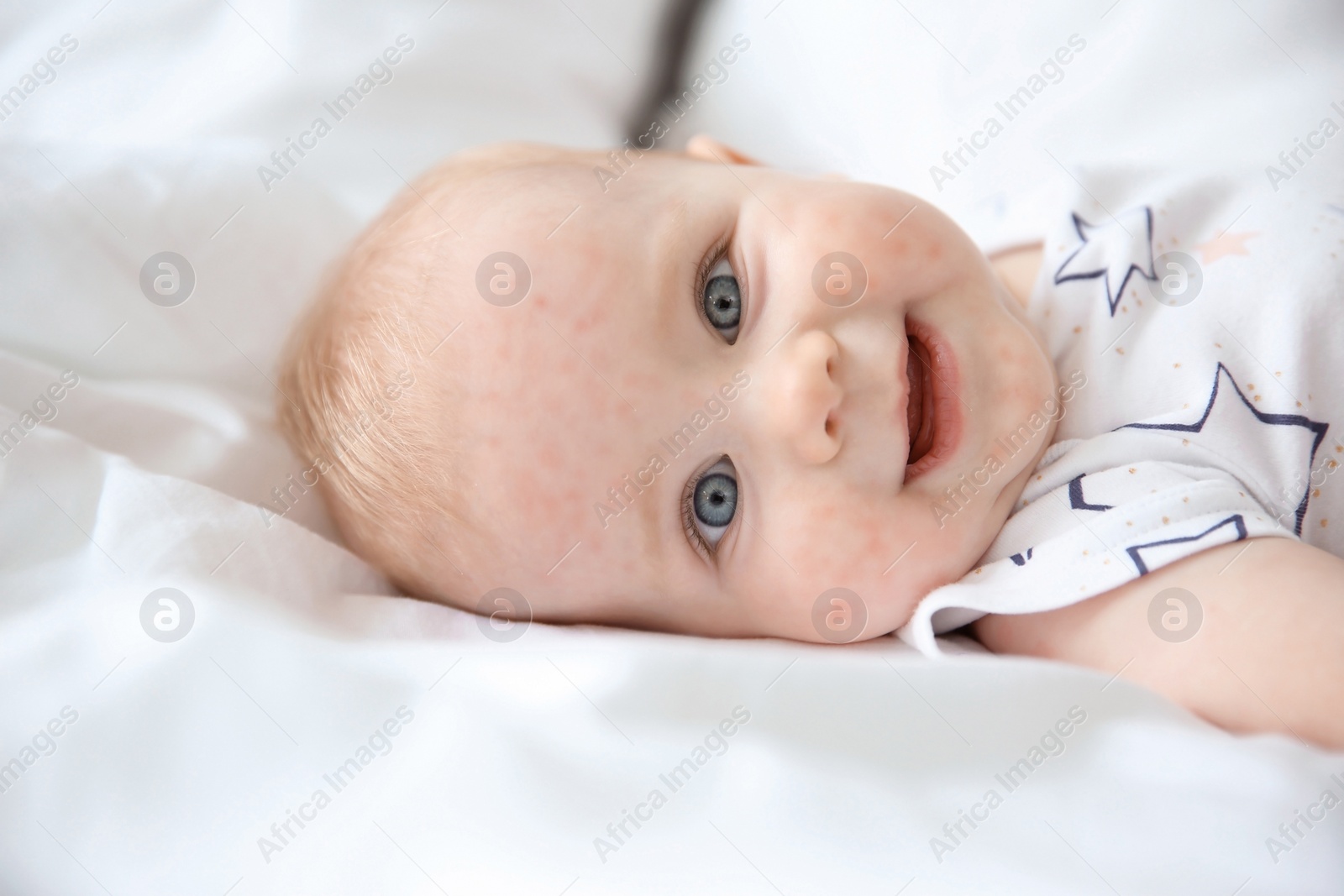 Image of Little child with red rash on bed. Baby allergies