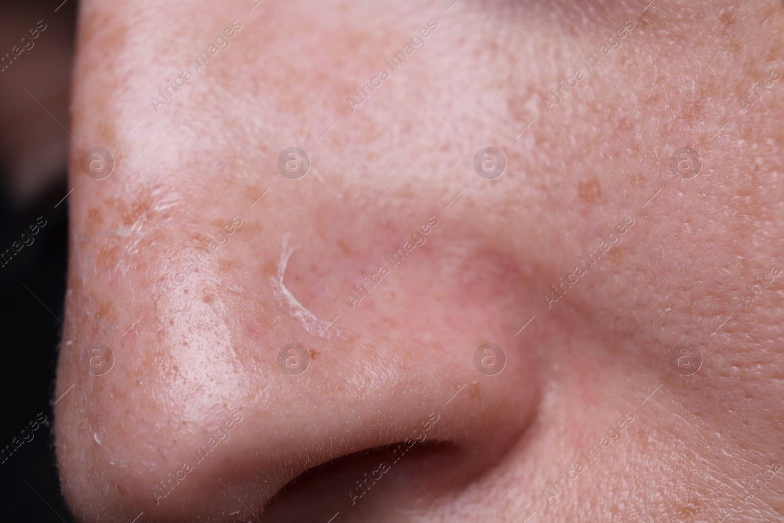 Photo of Woman with dry skin on nose, macro view