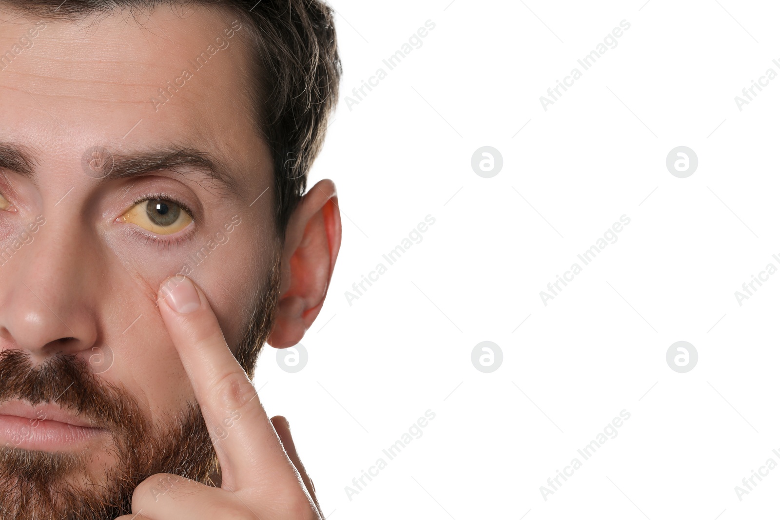 Photo of Man with yellow eyes on white background, closeup. Symptom of hepatitis