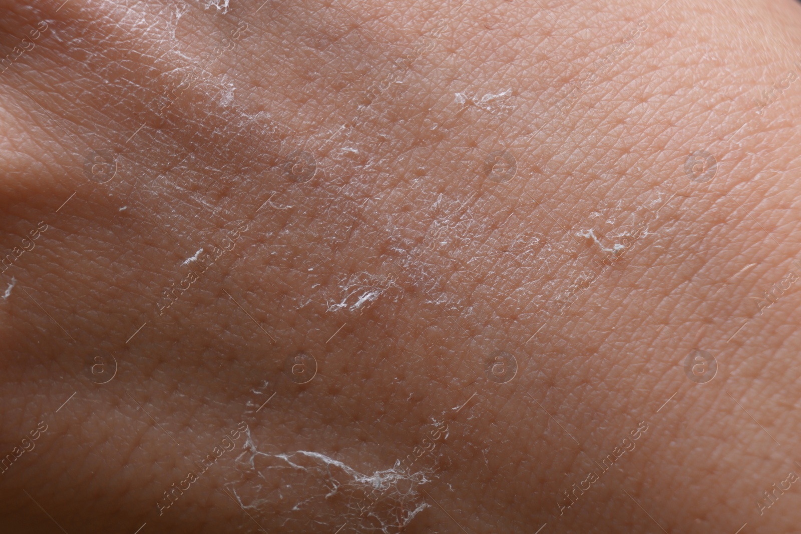 Photo of Woman with dry skin on hand, macro view