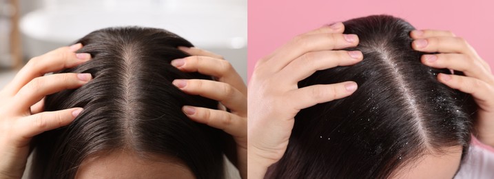 Woman showing hair before and after dandruff treatment on color backgrounds, collage