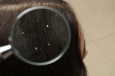 Photo of Closeup of woman with dandruff in her hair on blurred background, view through magnifying glass