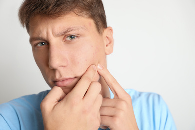 Photo of Teen guy with acne problem squeezing pimple on light background