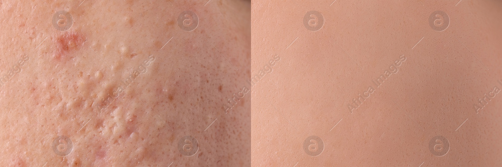 Image of Collage with photos of person suffering from acne before and after treatment, closeup. Banner design showing affected and healthy skin