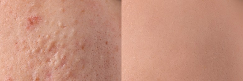 Collage with photos of person suffering from acne before and after treatment, closeup. Banner design showing affected and healthy skin