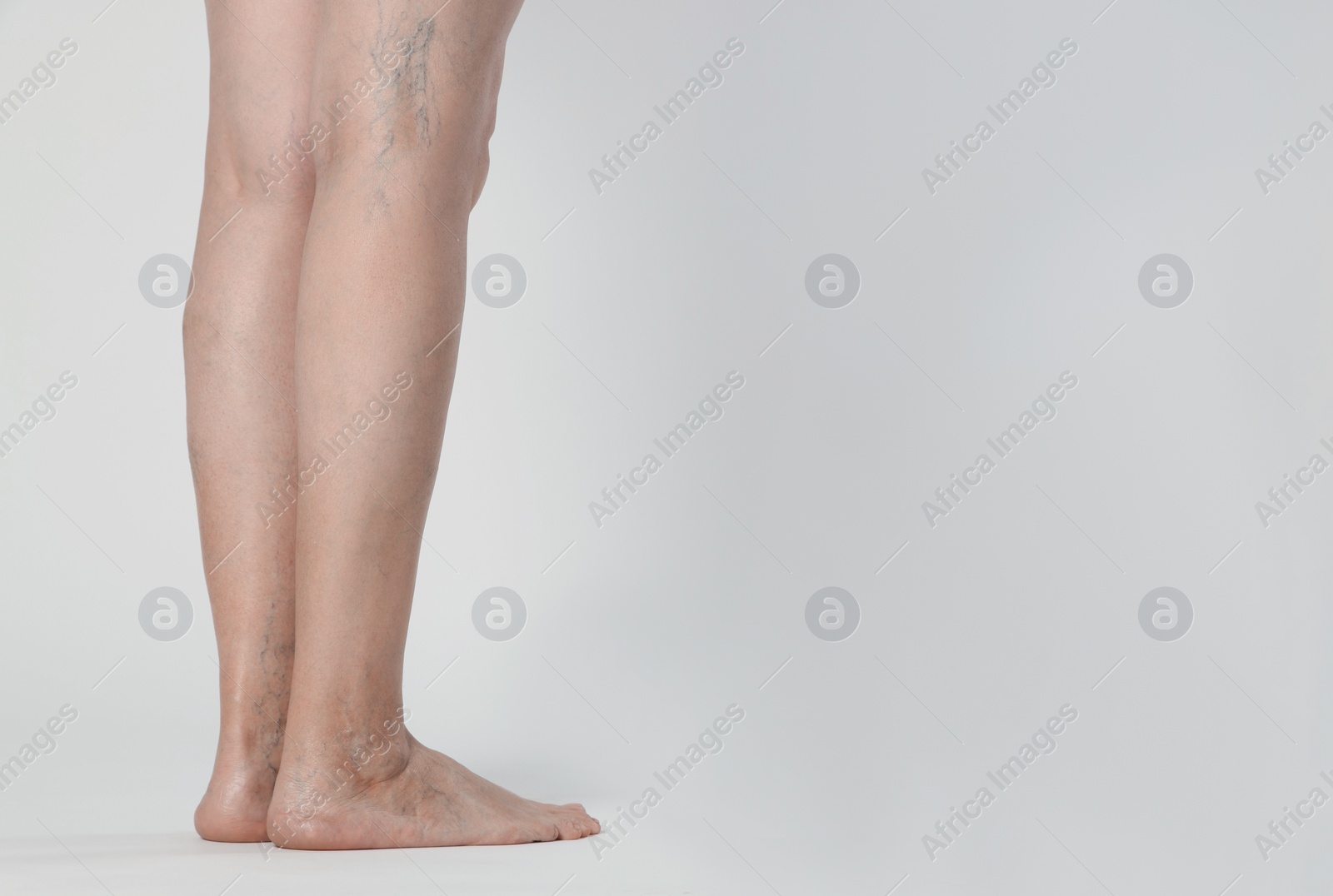 Photo of Closeup view of woman with varicose veins on light background. Space for text