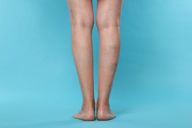 Photo of Closeup view of woman with varicose veins on light blue background