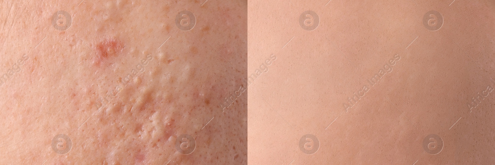 Image of Collage with photos of person suffering from acne before and after treatment, closeup. Banner design showing affected and healthy skin