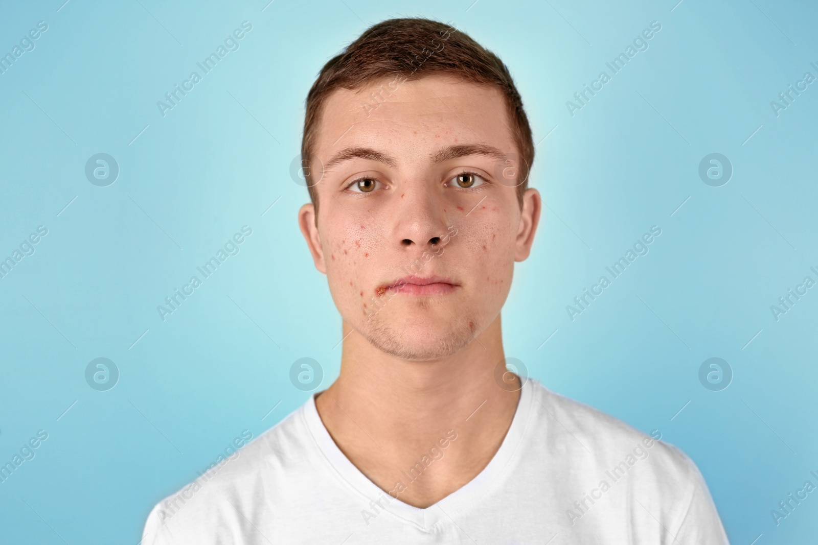 Photo of Young man with acne problem on color background