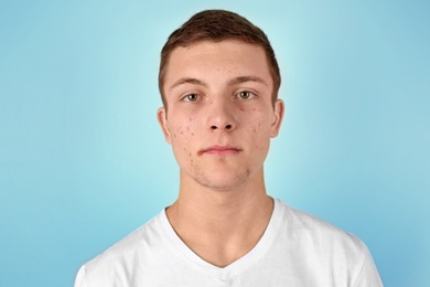 Young man with acne problem on color background