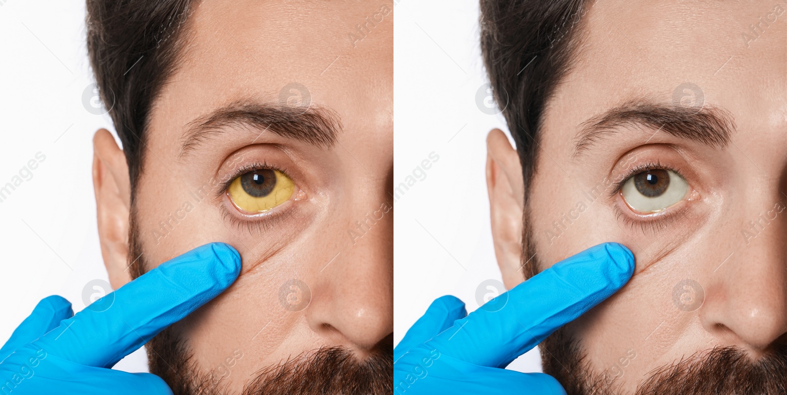 Image of Collage with photos of man before and after hepatitis treatment. Doctor checking patient on white background, closeup