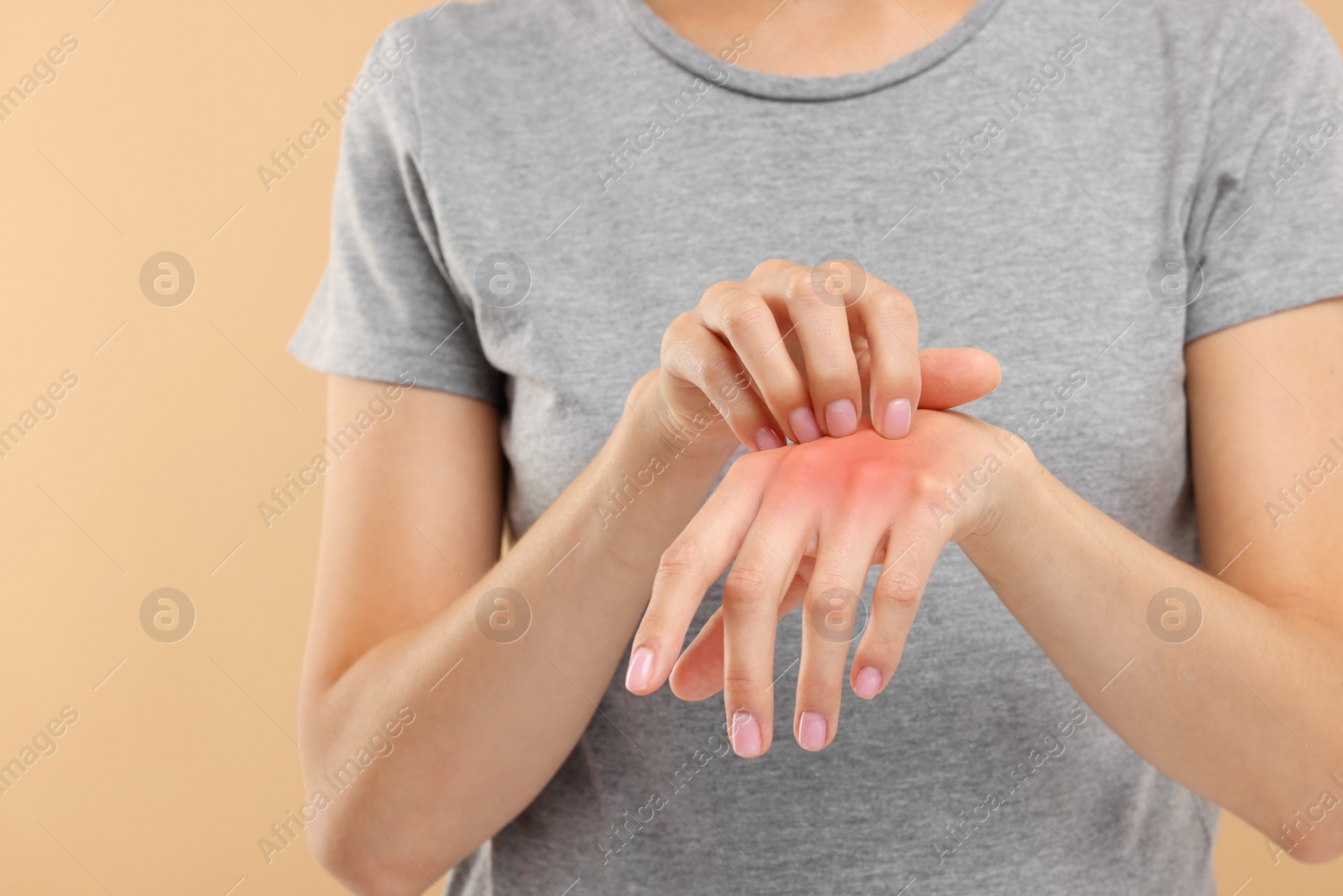 Photo of Suffering from allergy. Young woman scratching her hand on beige background, closeup