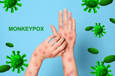 Image of Woman with rash suffering from monkeypox virus on light blue background, closeup