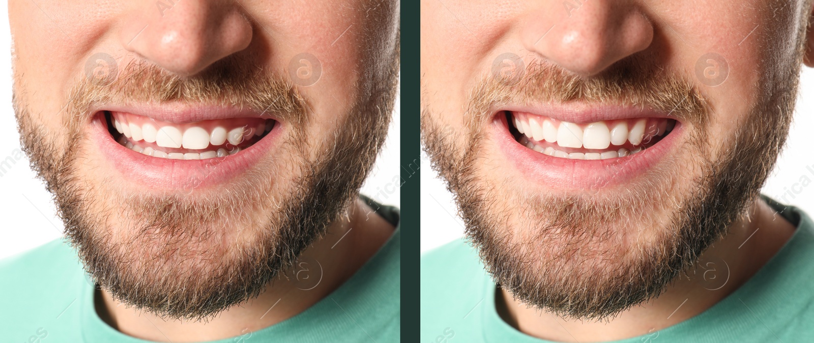 Image of Young man before and after gingivoplasty procedure, closeup. Banner design