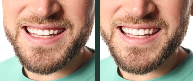 Young man before and after gingivoplasty procedure, closeup. Banner design