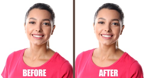 Image of Woman before and after gingivoplasty procedure on white background. Banner design