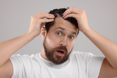Photo of Emotional man with dandruff in his dark hair on light gray background