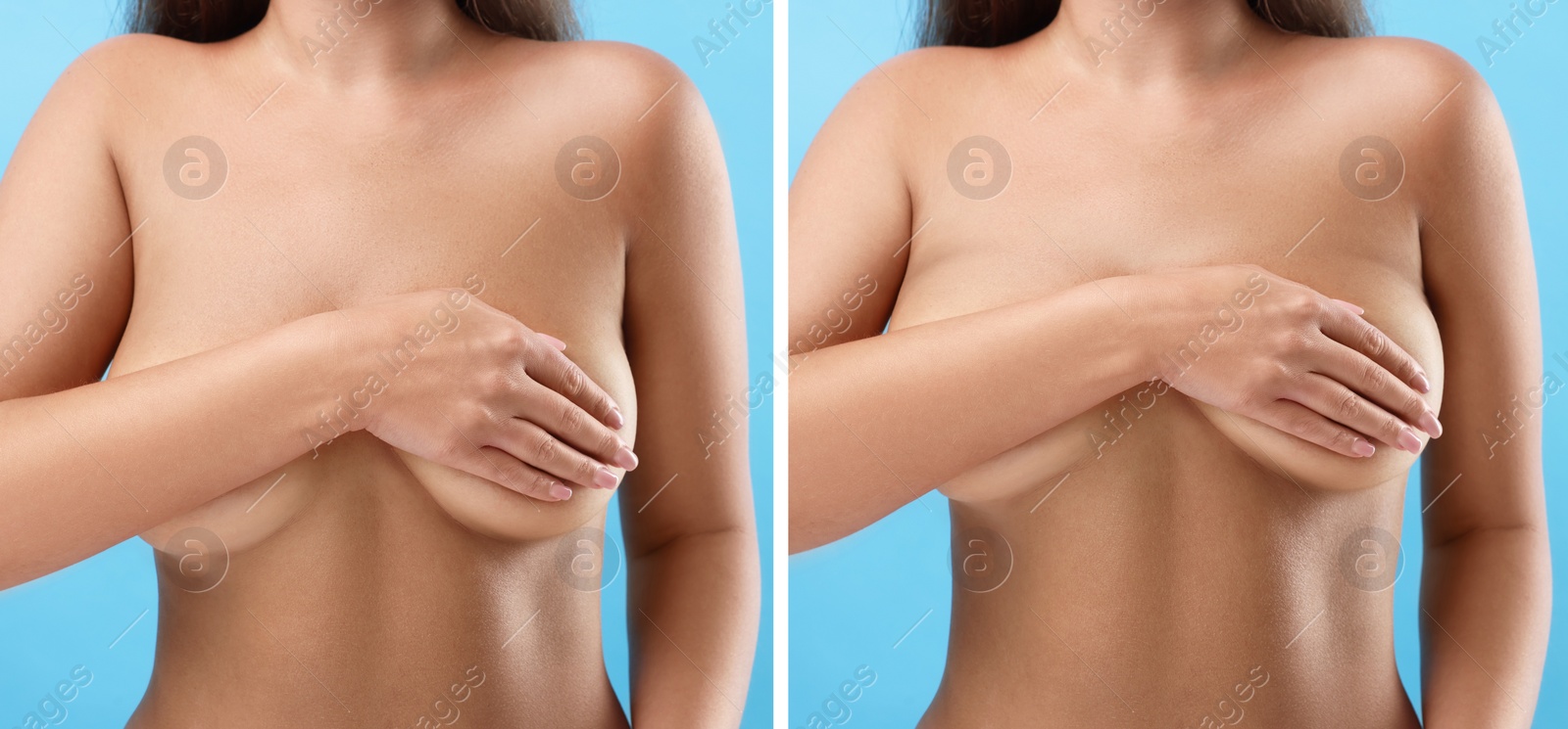 Image of Collage with photos of woman before and after breast-lift surgery on light blue background, closeup