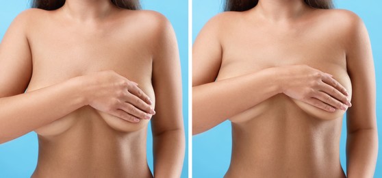 Collage with photos of woman before and after breast-lift surgery on light blue background, closeup
