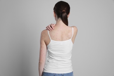 Photo of Woman with rash suffering from monkeypox virus on light grey background, back view