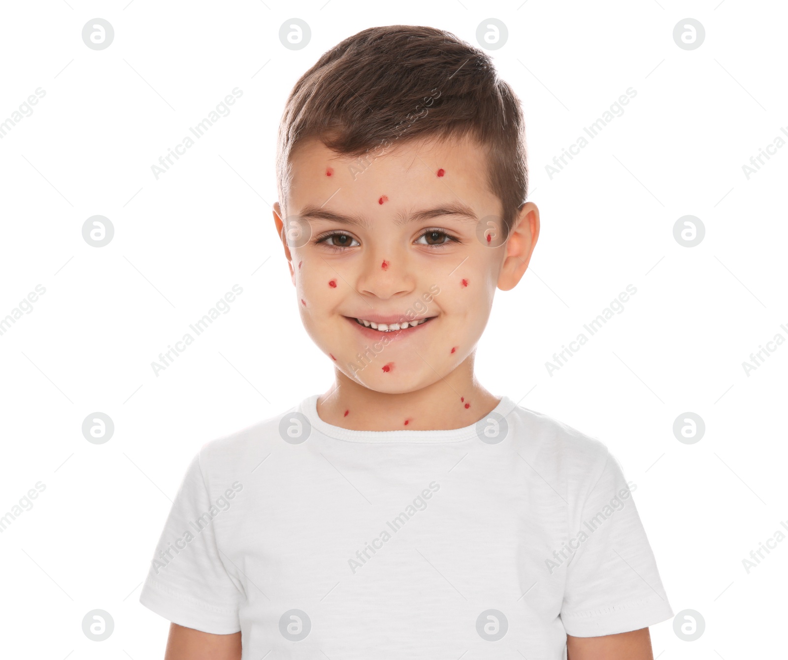 Photo of Little boy with chickenpox on white background