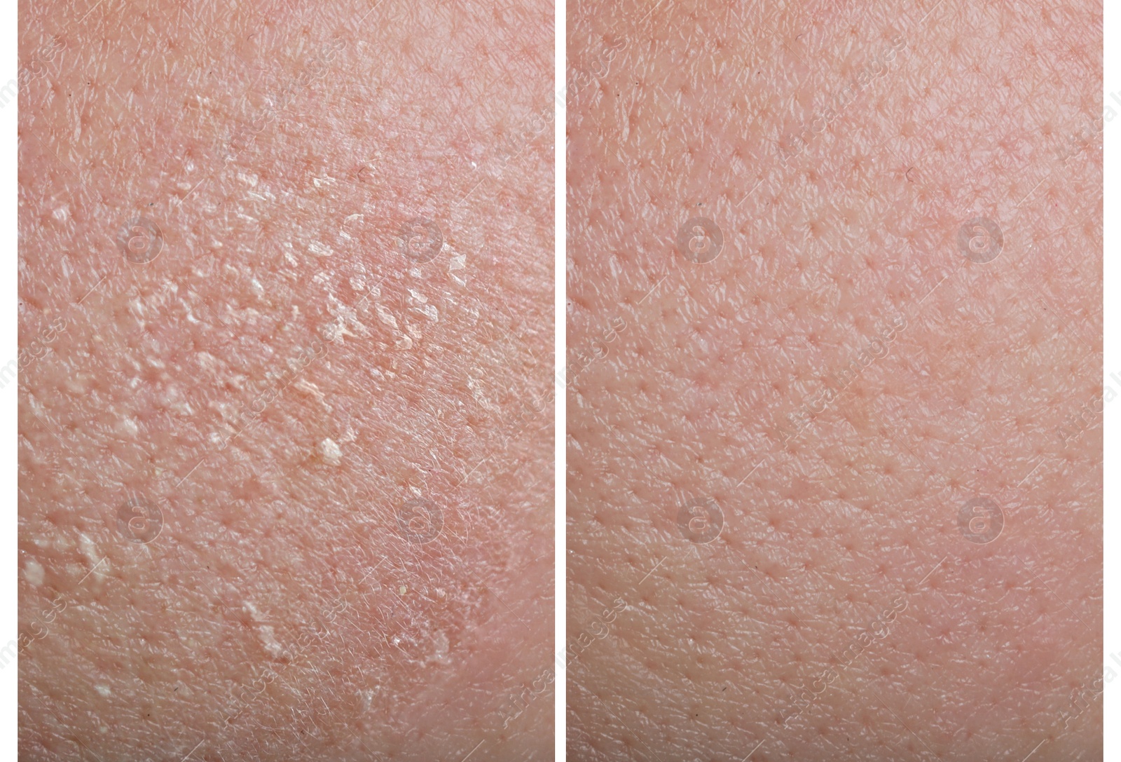 Image of Collage demonstrating comparison of dry and moisturized human skin, closeup