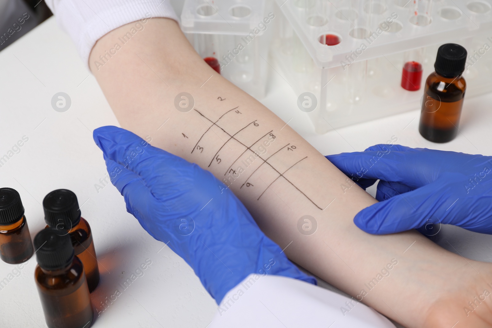 Photo of Doctor doing skin allergy test at light table, closeup