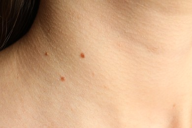 Photo of Closeup view of woman's body with birthmarks