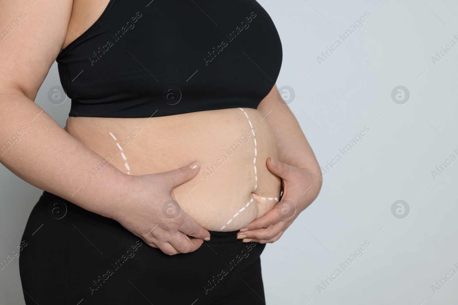 Photo of Closeup view of obese woman with marks on body against light background, space for text. Weight loss surgery