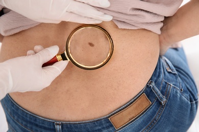 Dermatologist examining mature patient's birthmark with magnifying glass in clinic, closeup