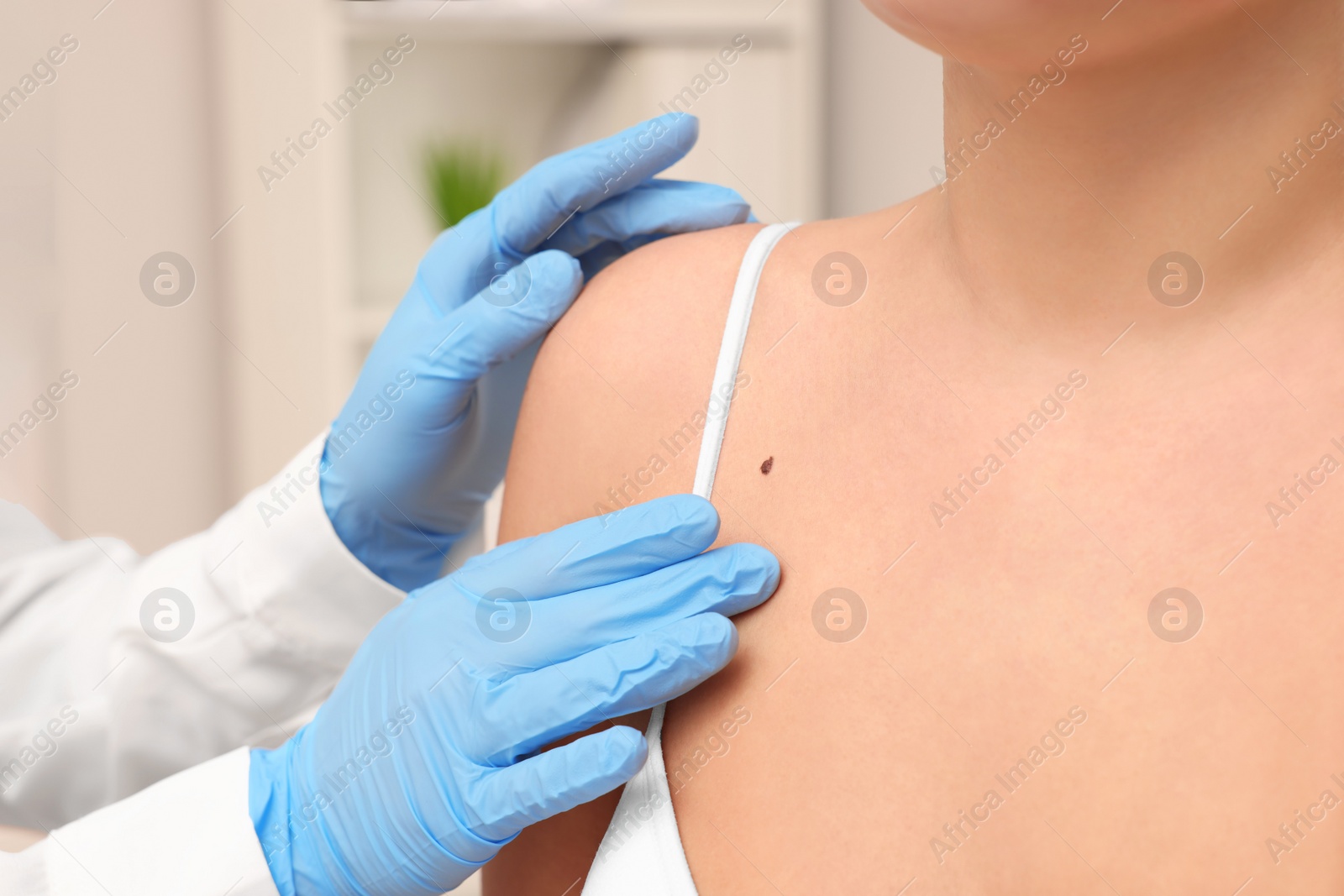 Photo of Dermatologist examining patient's birthmark indoors, closeup view