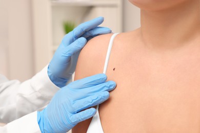 Dermatologist examining patient's birthmark indoors, closeup view