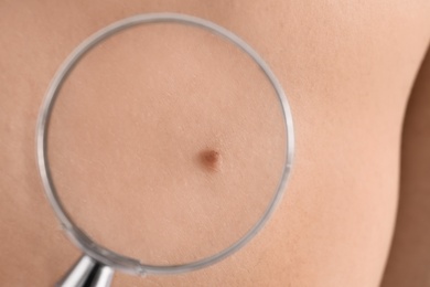 Photo of Birthmark of patient under magnifying glass, closeup view. Visiting dermatologist
