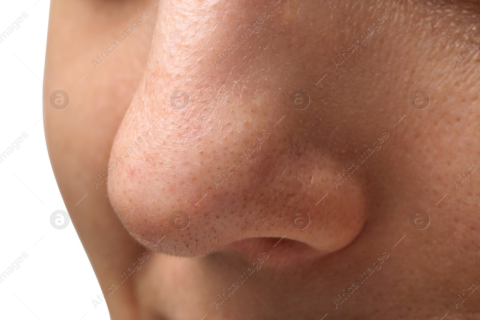 Photo of Young woman with acne problem on white background, closeup view of nose