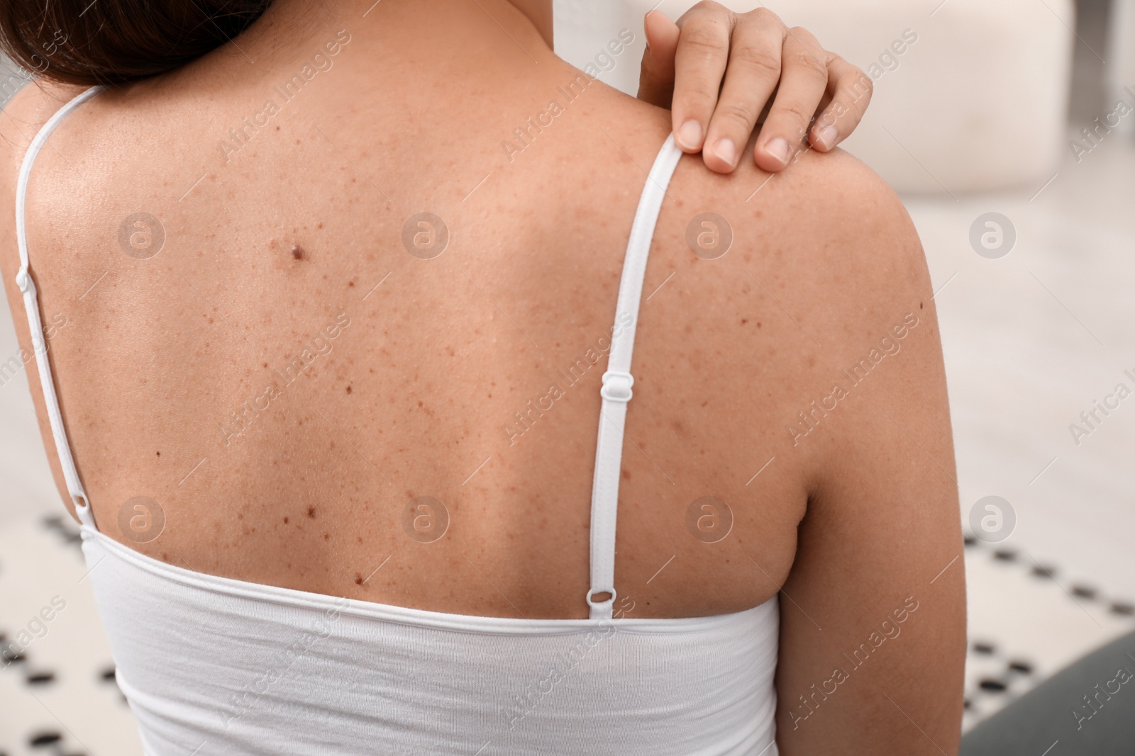 Photo of Closeup of woman`s body with birthmarks indoors, back view