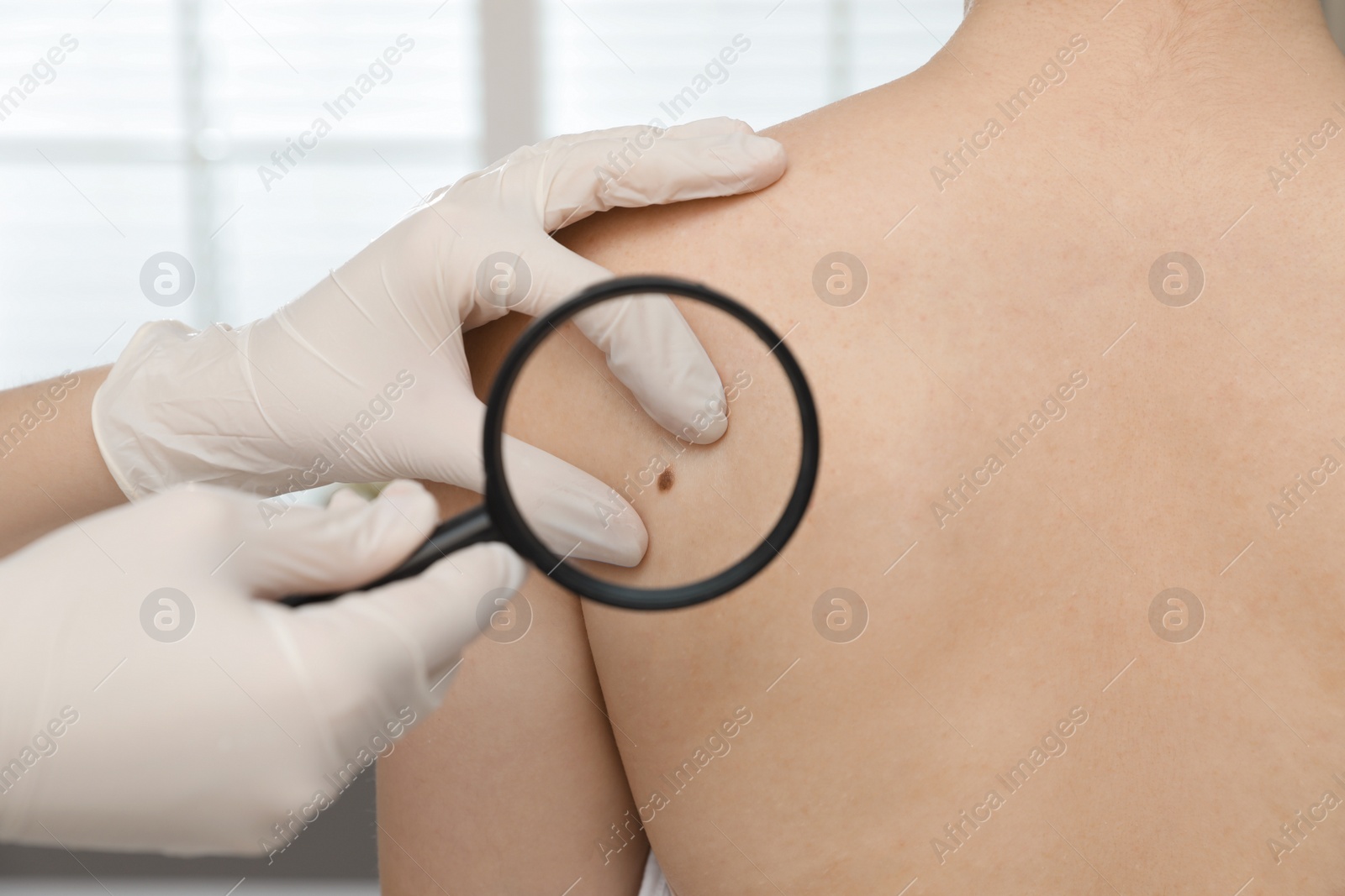 Photo of Dermatologist examining patient's birthmark with magnifying glass in clinic, closeup view