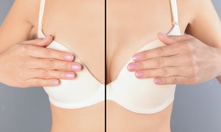 Image of Breast augmentation with silicone implant. Photo of woman divided in halves before and after plastic surgery, collage on grey background