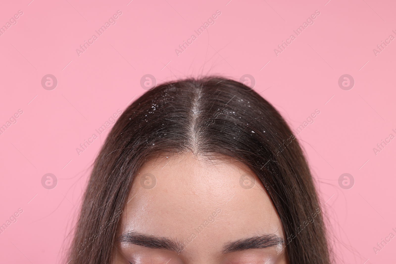 Photo of Woman with dandruff problem on pink background, closeup