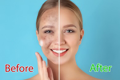 Image of Young woman before and after cosmetic procedure on light blue background