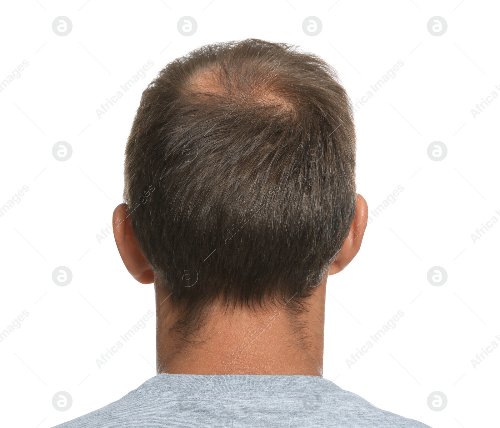 Photo of Man with hair loss problem on white background, back view