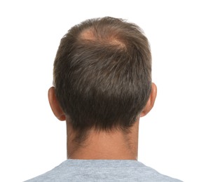 Man with hair loss problem on white background, back view