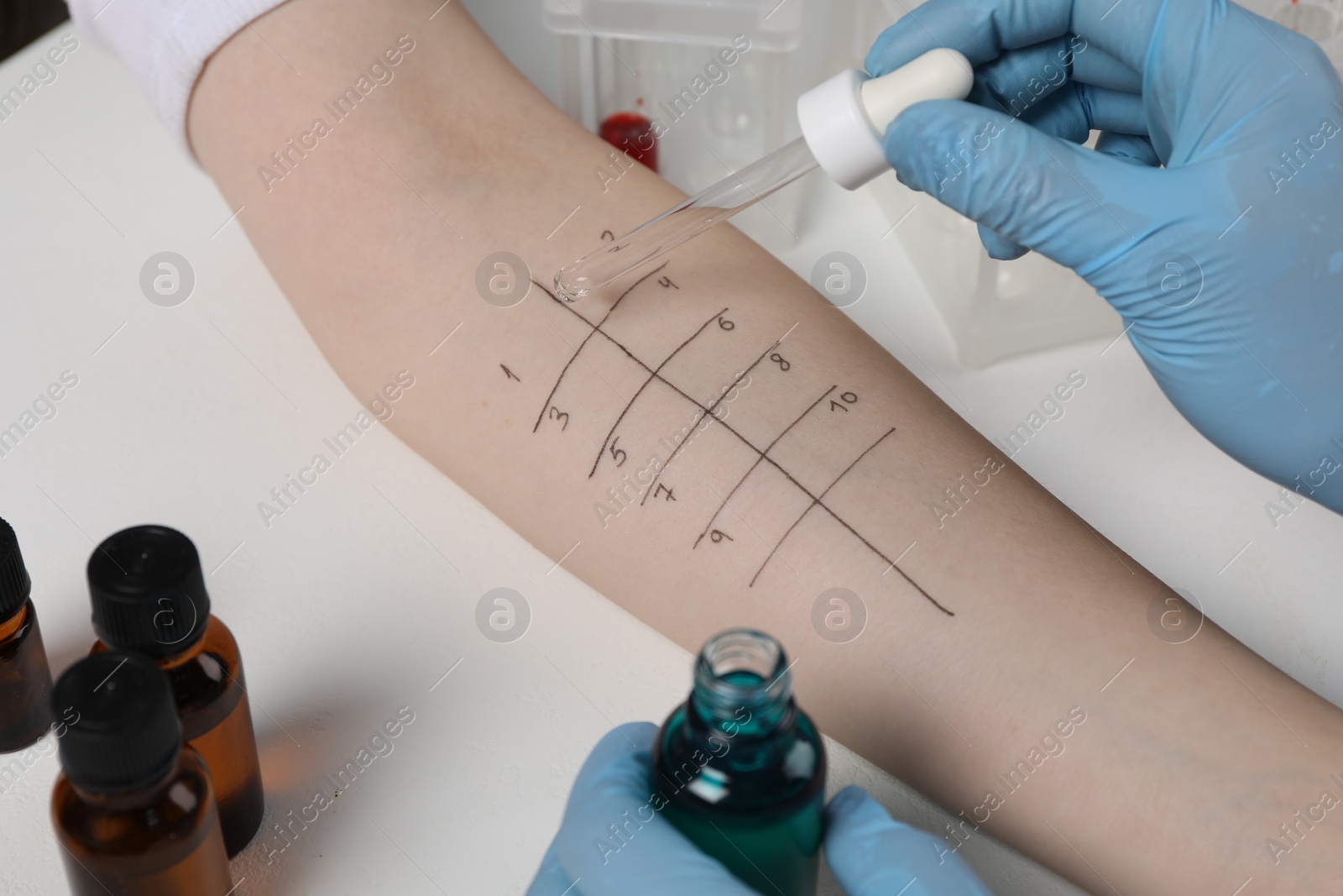 Photo of Doctor doing skin allergy test at light table, closeup