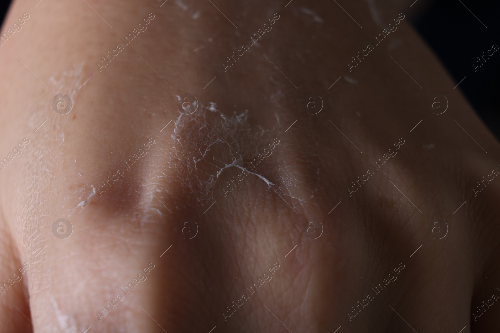 Photo of Woman with dry skin on hand, macro view