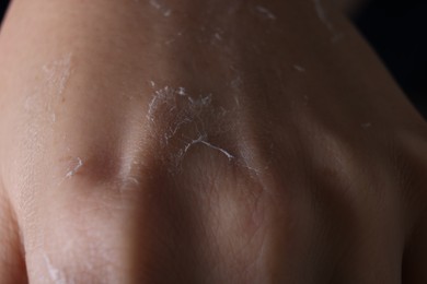 Photo of Woman with dry skin on hand, macro view