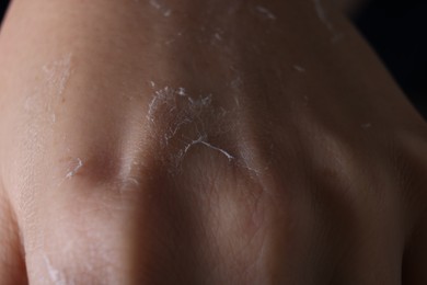 Woman with dry skin on hand, macro view