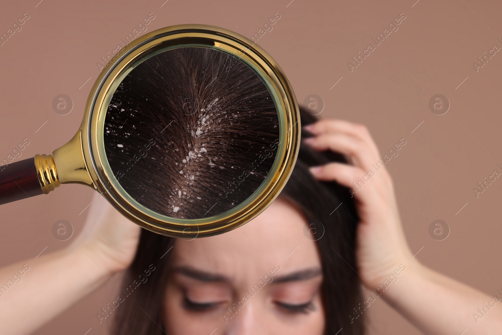 Image of Woman suffering from dandruff on pale brown background, closeup. View through magnifying glass on hair with flakes