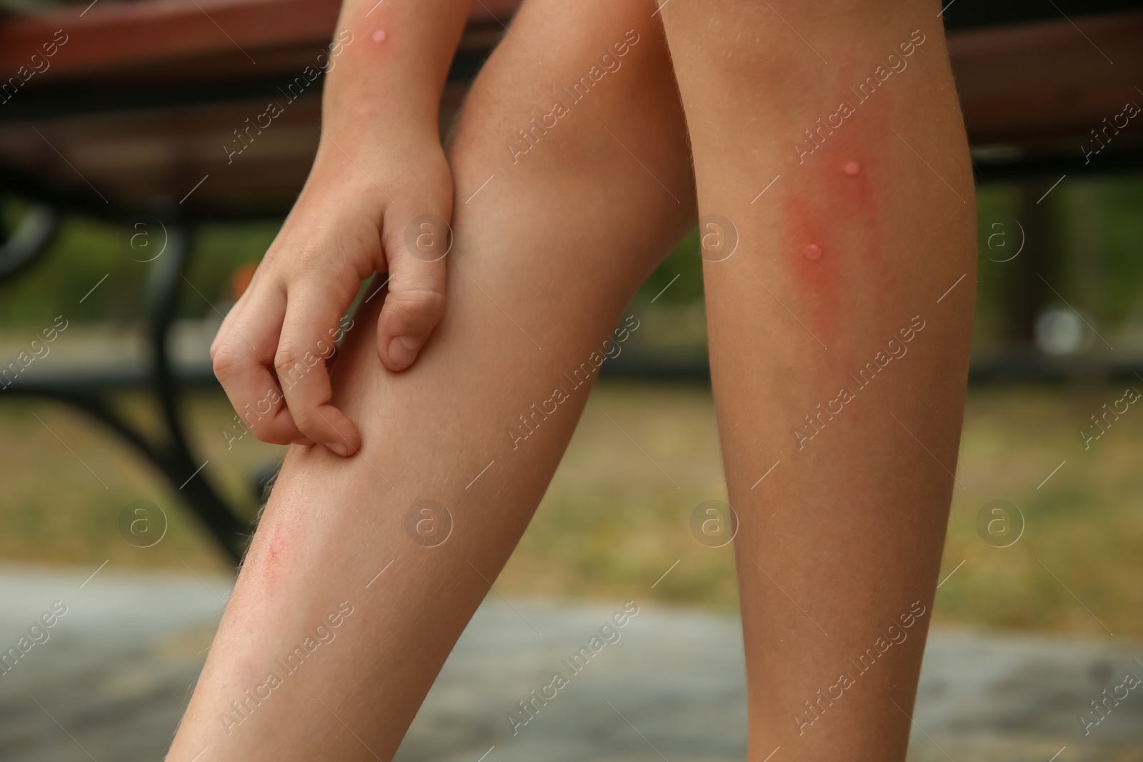 Photo of Girl scratching leg with insect bite outdoors, closeup