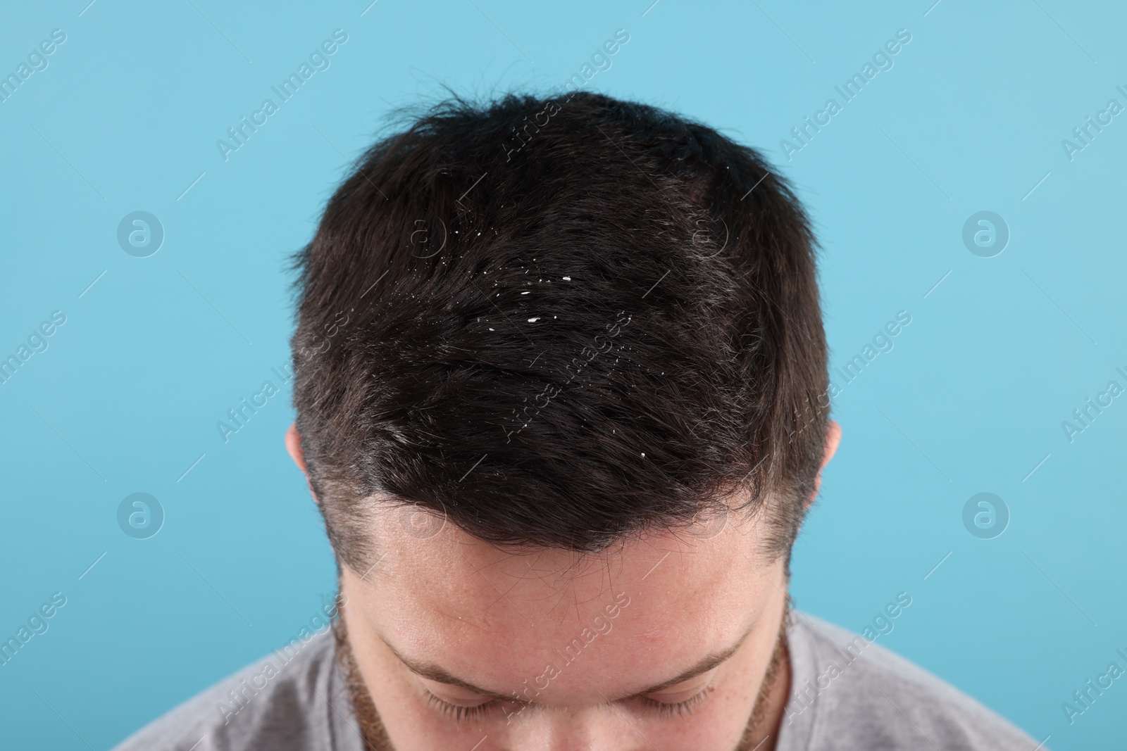 Photo of Man with dandruff in his dark hair on light blue background, closeup